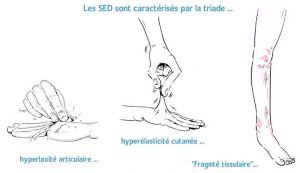 EDS 1 Ehlers-Danlos syndrom