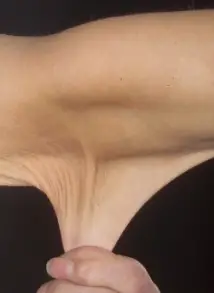 EDS 2 Ehlers-Danlos syndrom