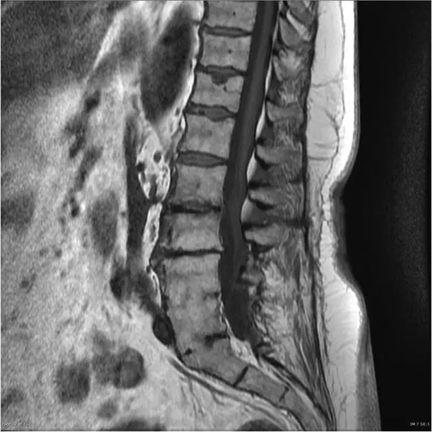 arachnoïdite diagnostiquée par irm