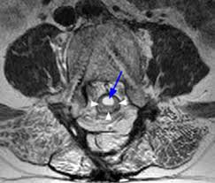 Arachnoiditis MRT