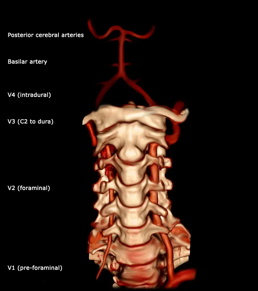 vertebral arterie set forfra
