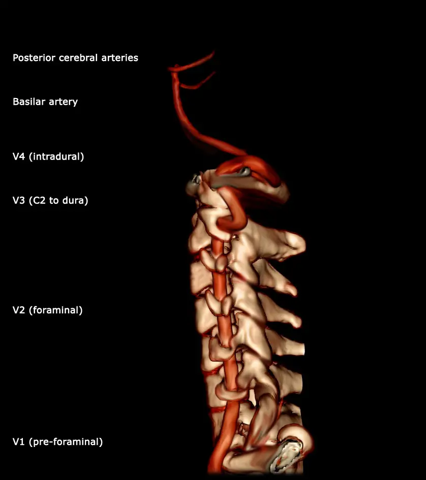 Profilansicht der A. vertebralis