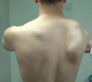 scapula alata icd 10