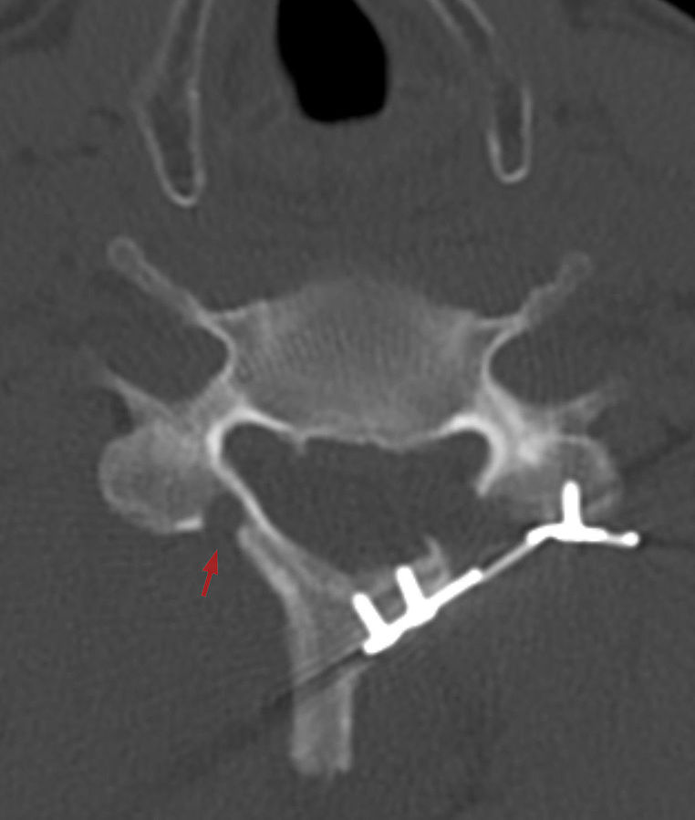 laminoplasty