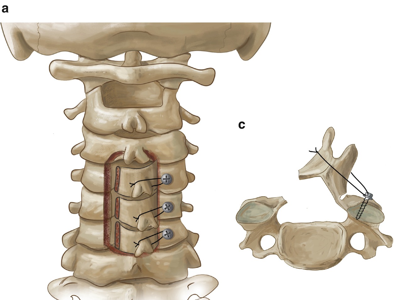 laminoplastia