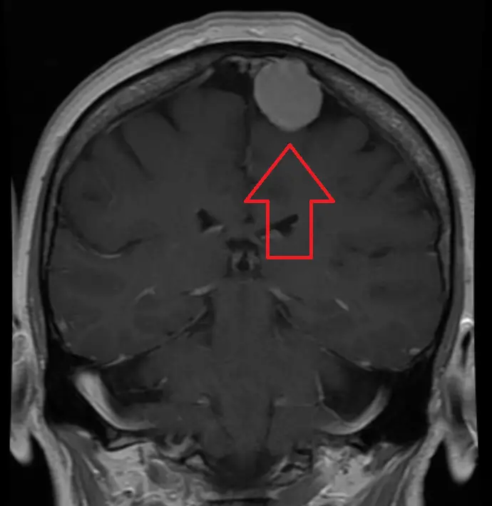 meningioma