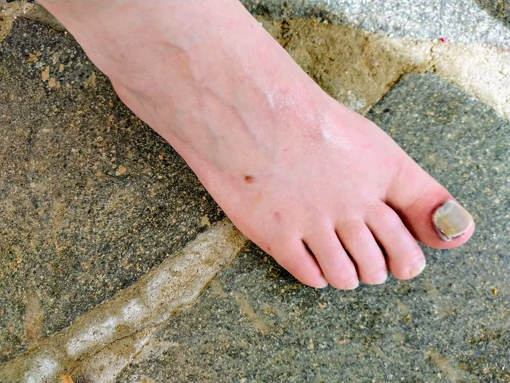 травма, вызывающая онемение пальца ноги