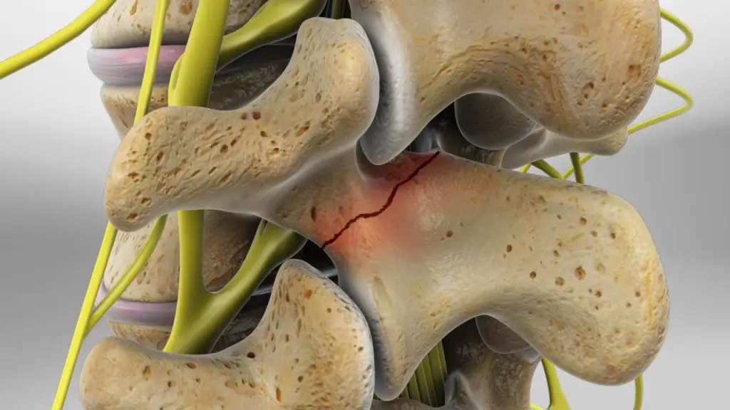 espondilolisis Espondilolistesis Reconocimiento de discapacidad