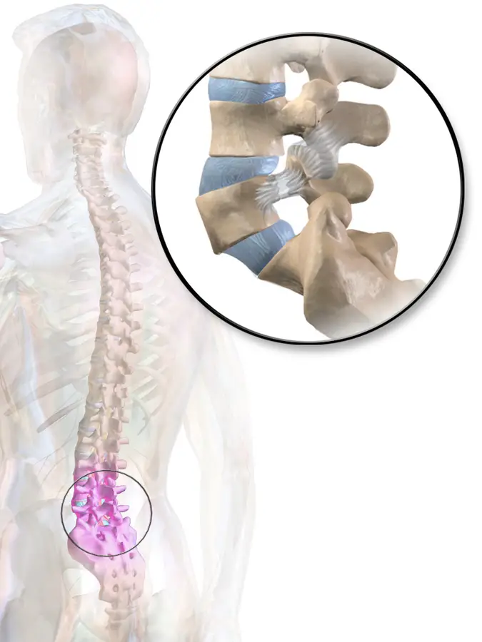 spondylolyse