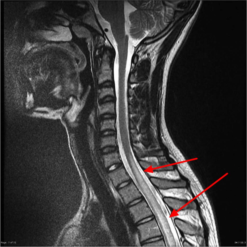 Sindrome della mielite trasversa della cauda equina