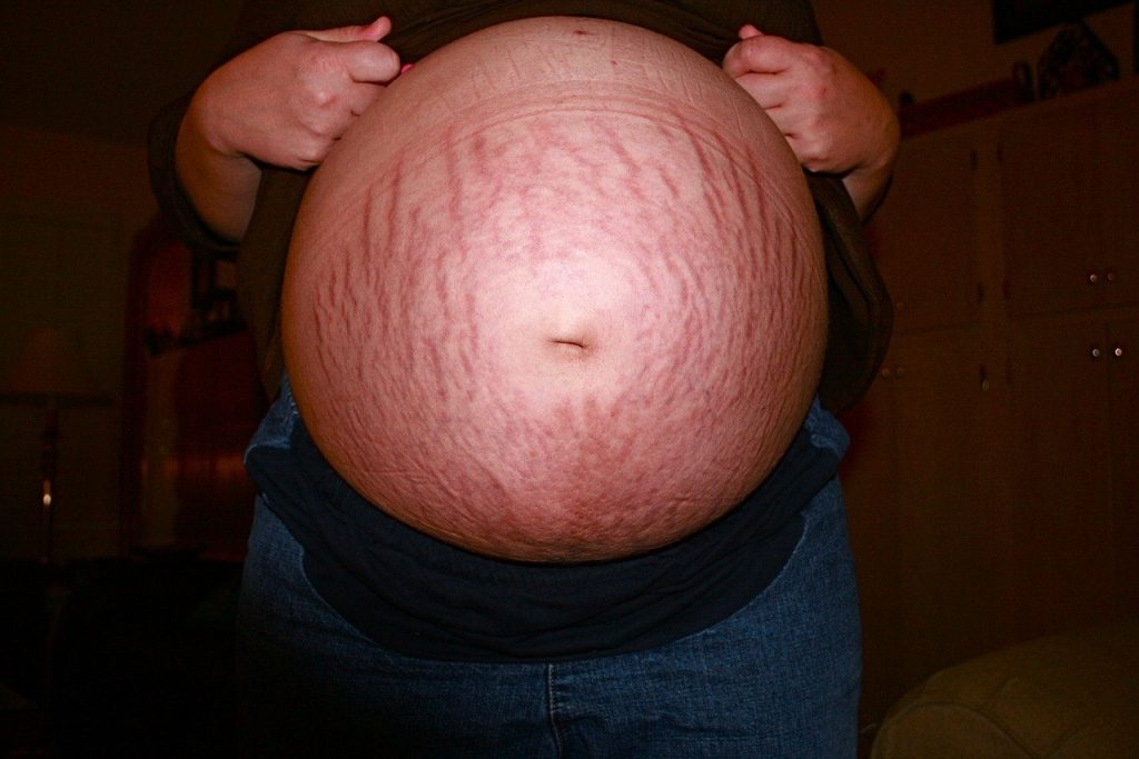 تمدد الجلد أثناء الحمل