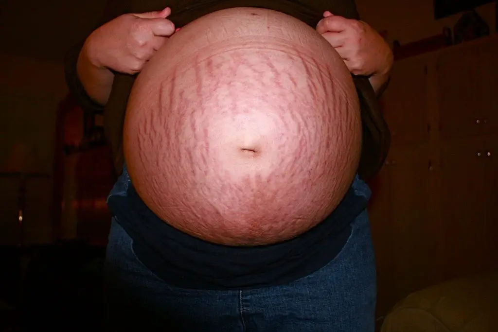 stretch mark during pregnancy