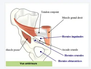 Crural arch inguinal hernia