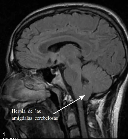 Arnold chiari 1 Arnold-Chiari malformation