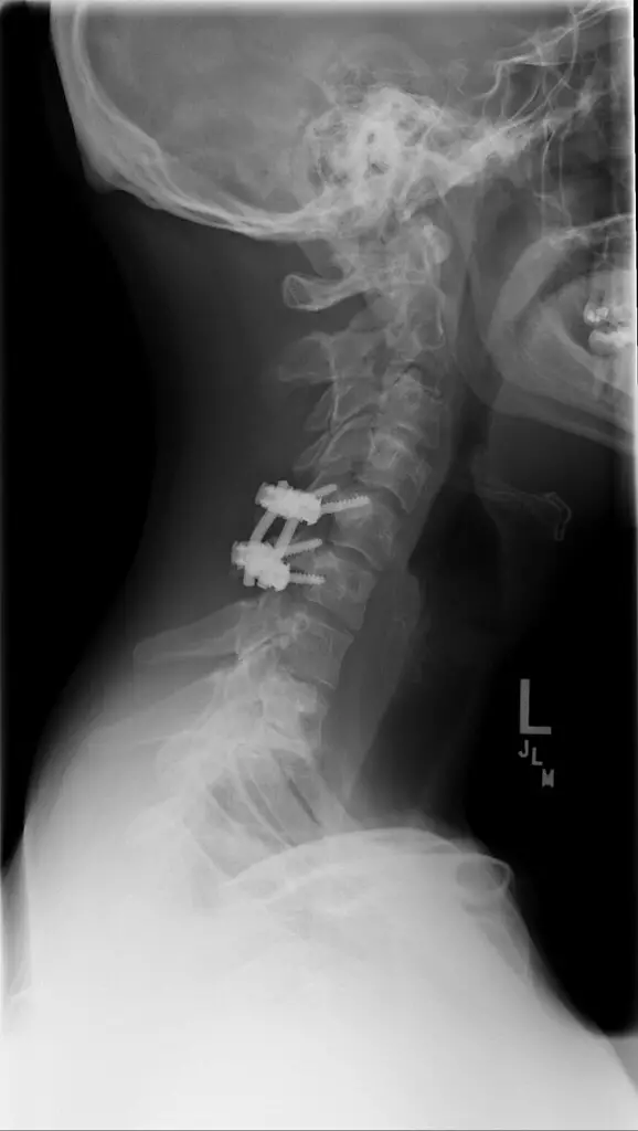 Cervical arthrodesis: Indications and postoperative course