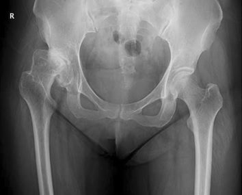 Dysplasie de la hanche chez l’adulte : que faire ?