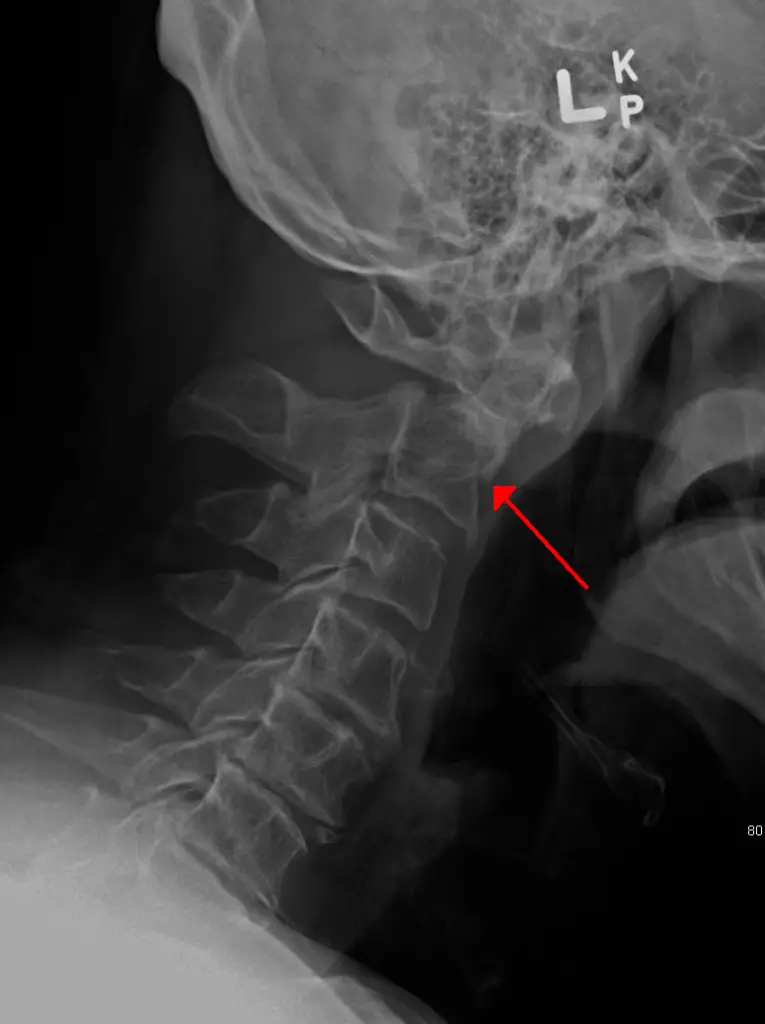 odontoid fracture