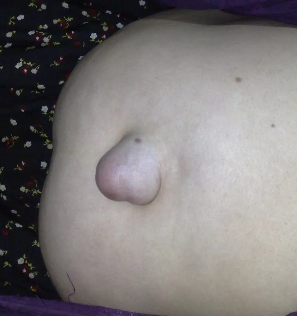 umbilical hernia