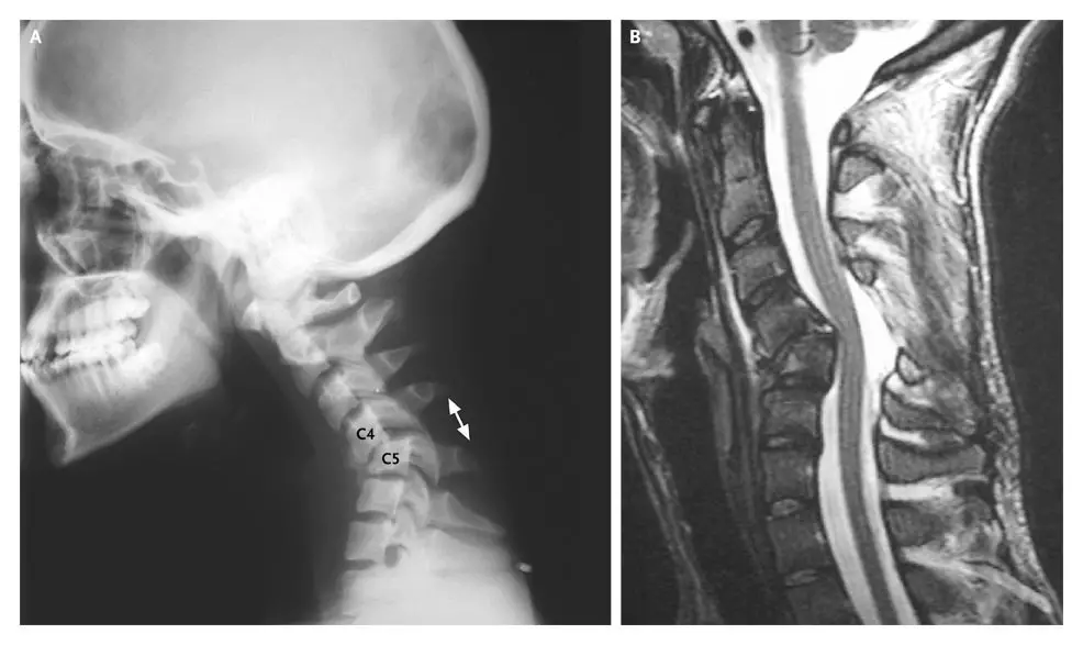 deslocamento cervical