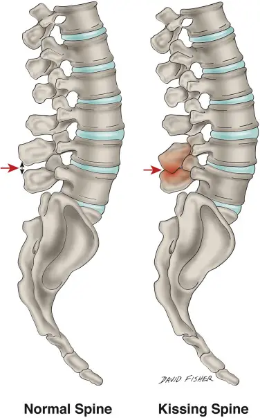 baastrup disease