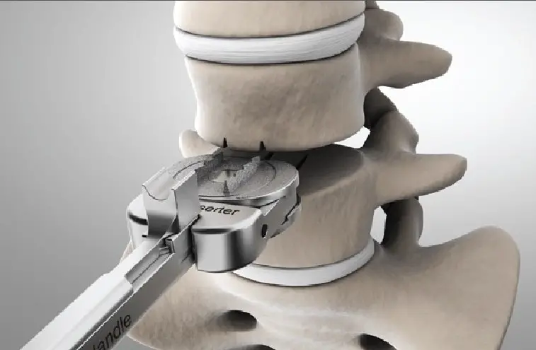 Bandscheibenprothese: Operation zur Korrektur von Bandscheibenschmerzen