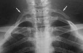 cervical rib syndrome