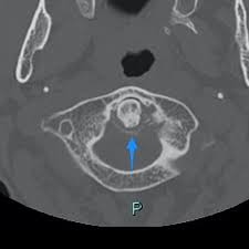 CDS Crown Tooth Syndrome