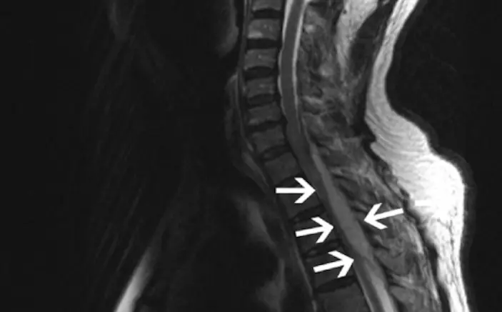 ascesso epidurale