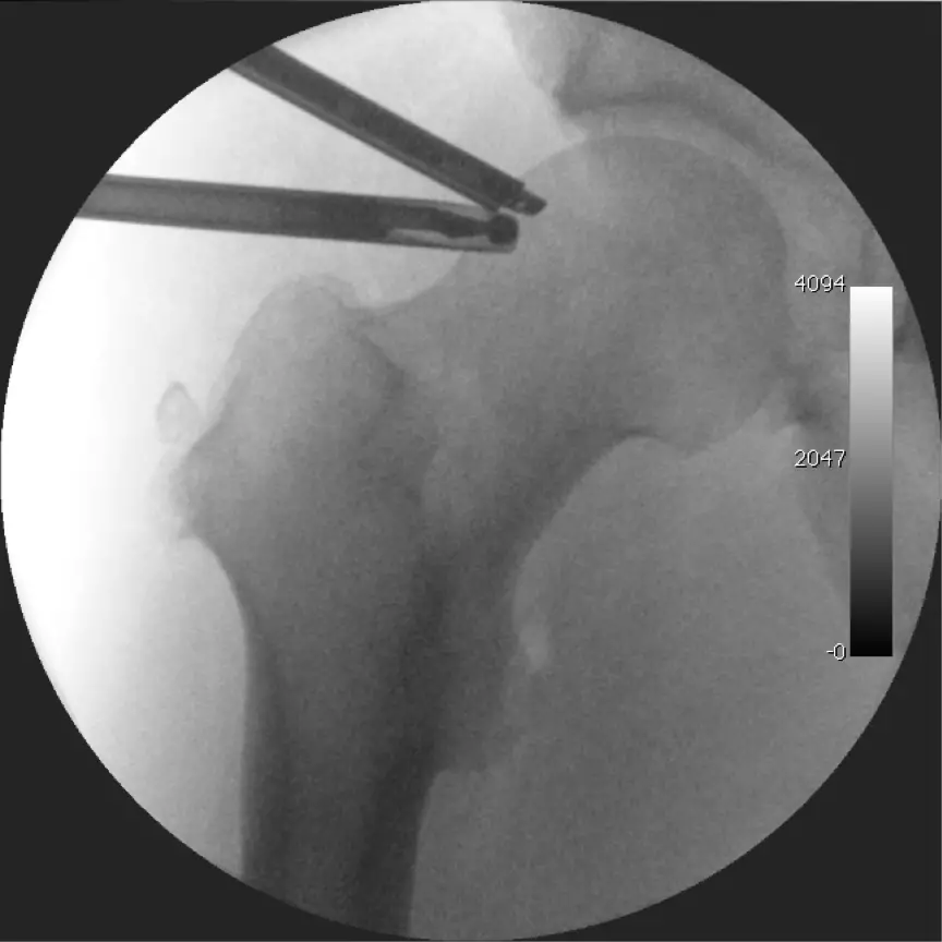 hip arthroscopy