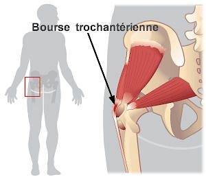 hoftebursitis