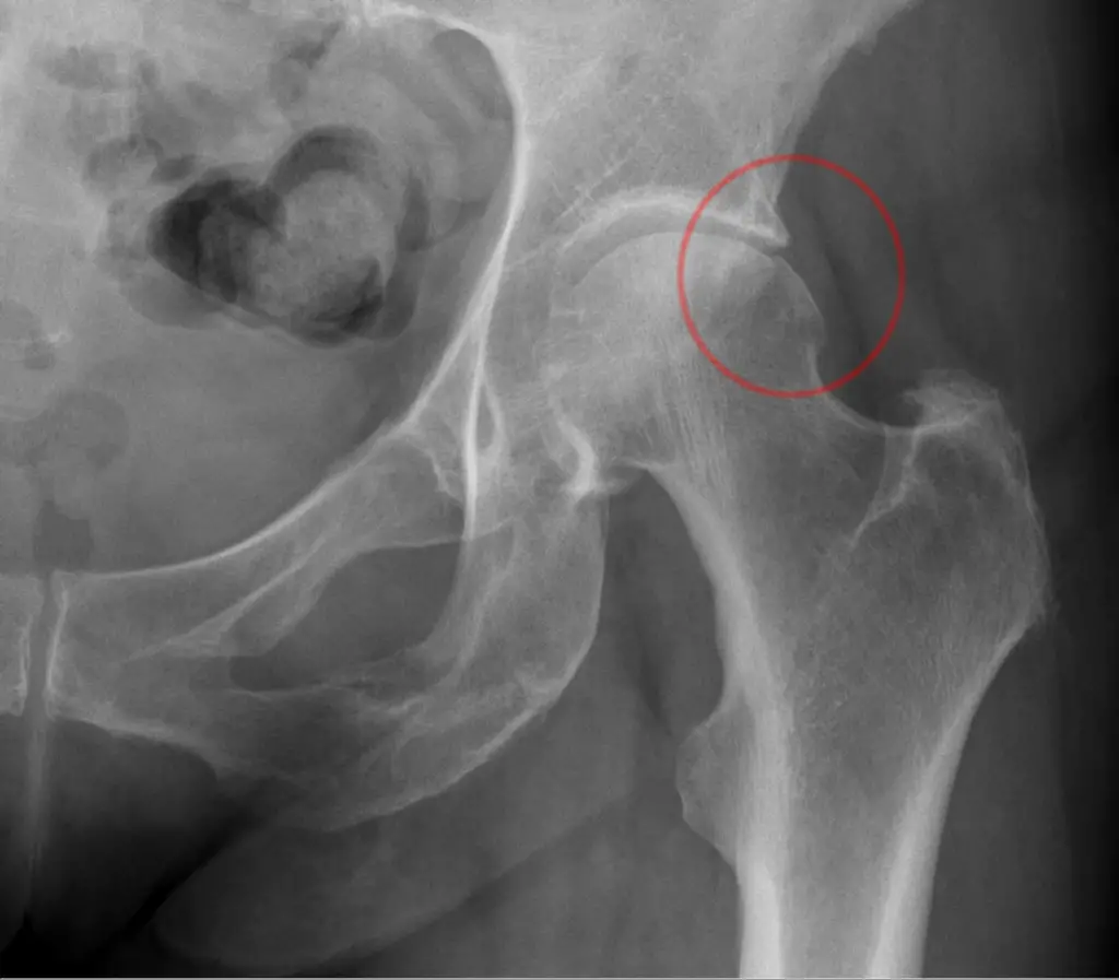 femoroacetabular impingement