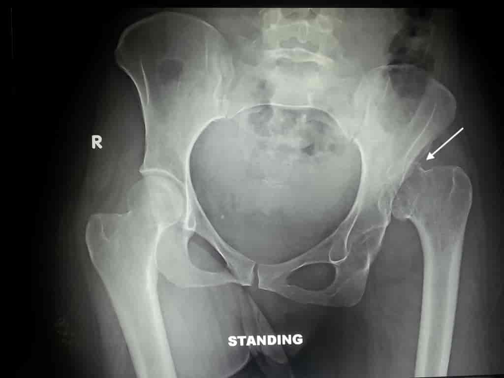 hip dislocation