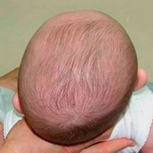 plagiocephaly