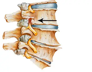 foraminal stenosis