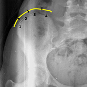 radiographie permettant d'évaluer le test de risser