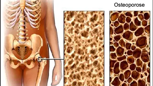 Ostéoporose: Définition et traitement (Éviter les fractures)