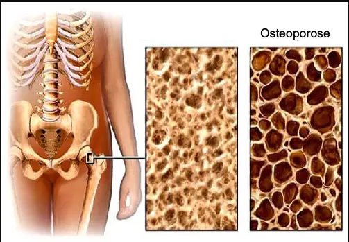 Osteoporose Trabekuläre Osteoporose