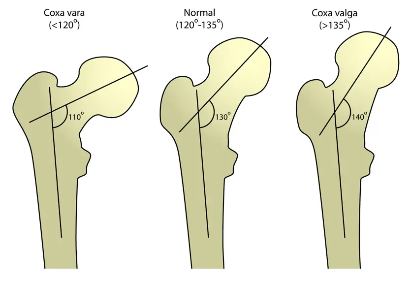 Coxa valga und Coxa vara