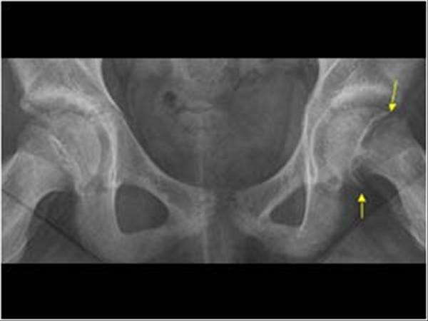 epifisiolisis de la cadera