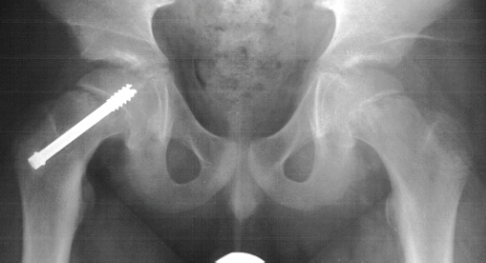cirurgia d'epifisiòlisi de l'articulació del maluc