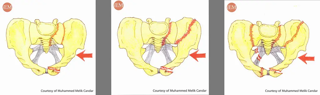 كسر الحوض