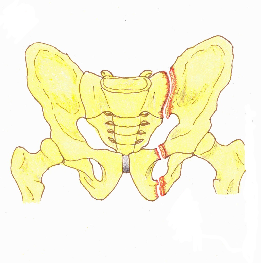 pelvic fracture3 Fracture of the pelvis without surgery