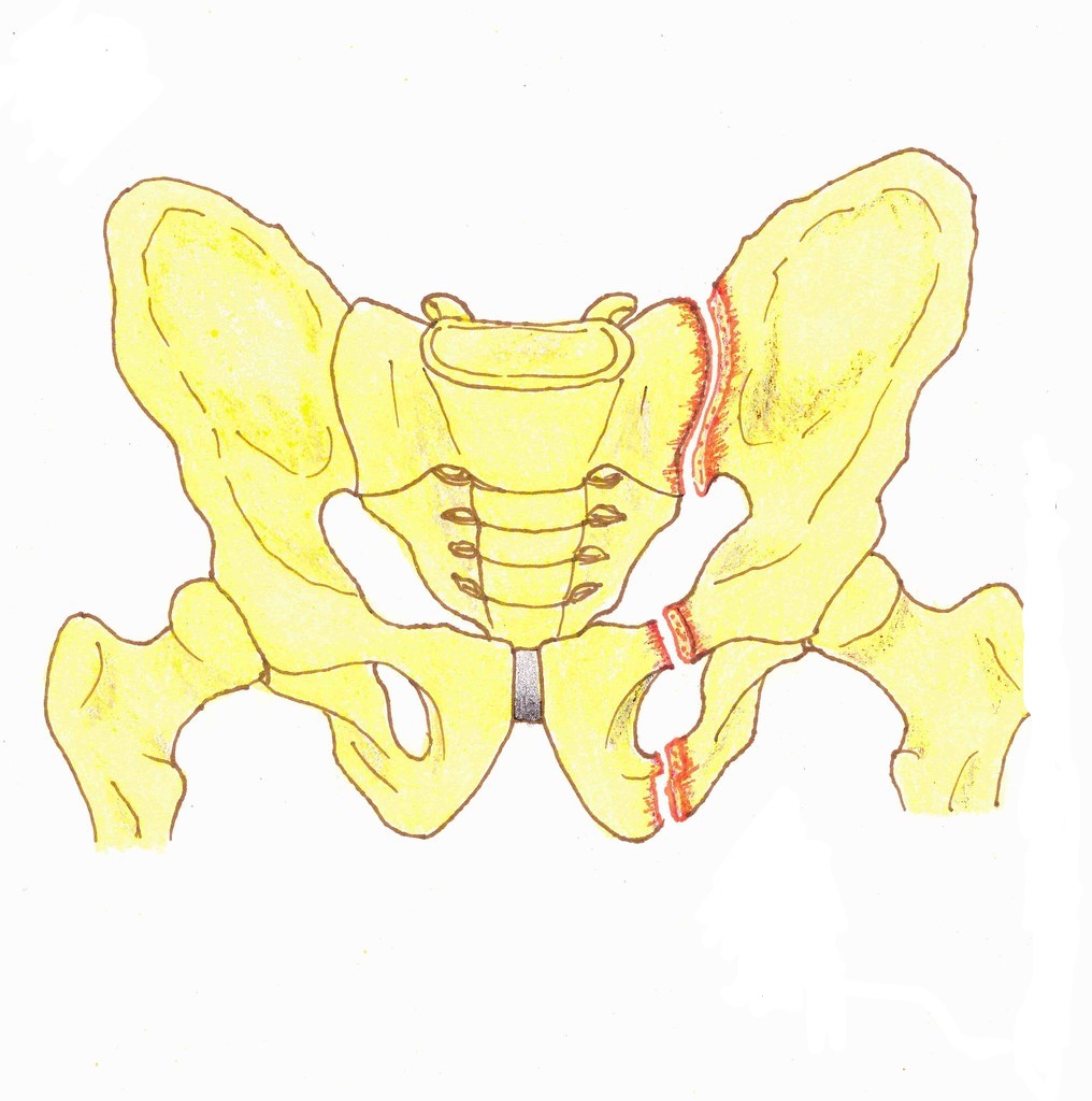 pelvic fracture3