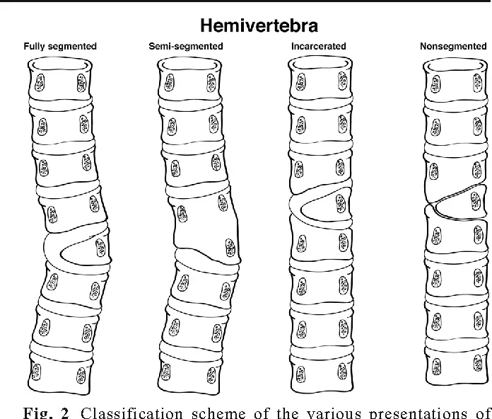 klassificering af hemivertebrae