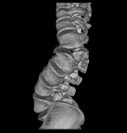 Hemivertebra: Spinal abnormitet (forbindelse med skoliose)