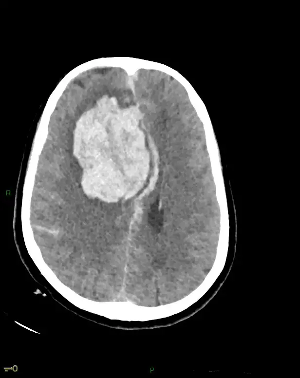 meningeal hemorrhage