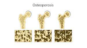 Laden Sie Osteoporose und Schmerzen herunter