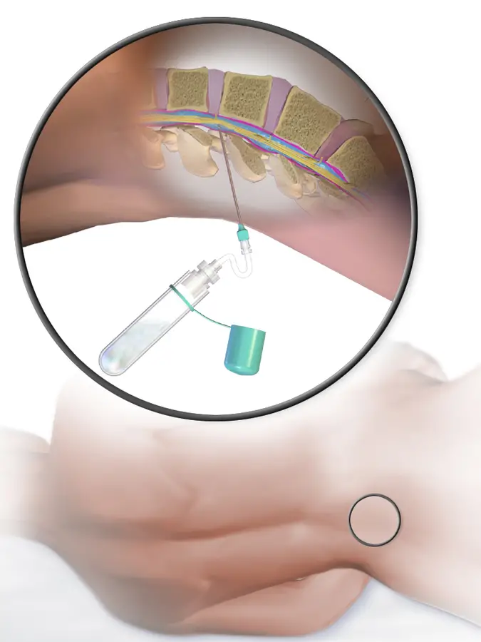 Ponction lombaire indications et risques (explications) Radiologie pour tous