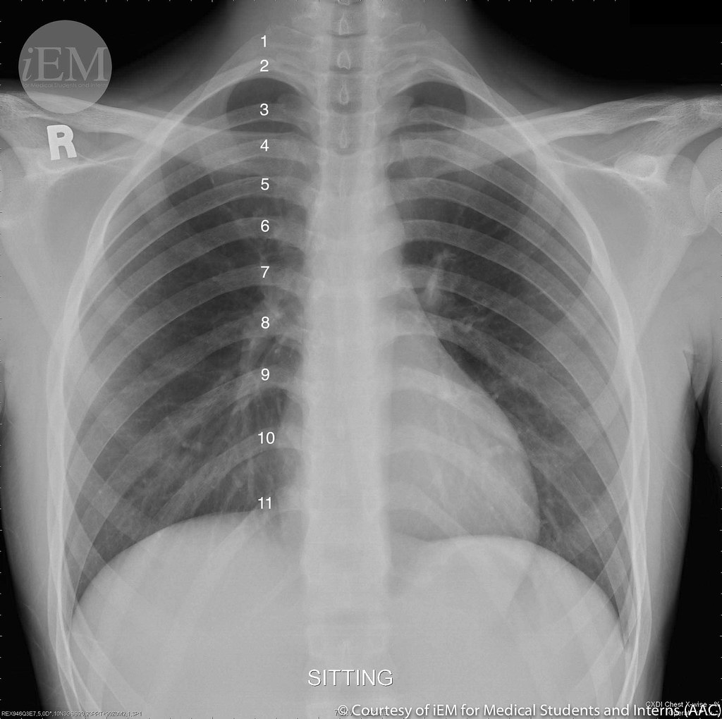 røntgen af ​​ribbenene for at diagnosticere costochondritis