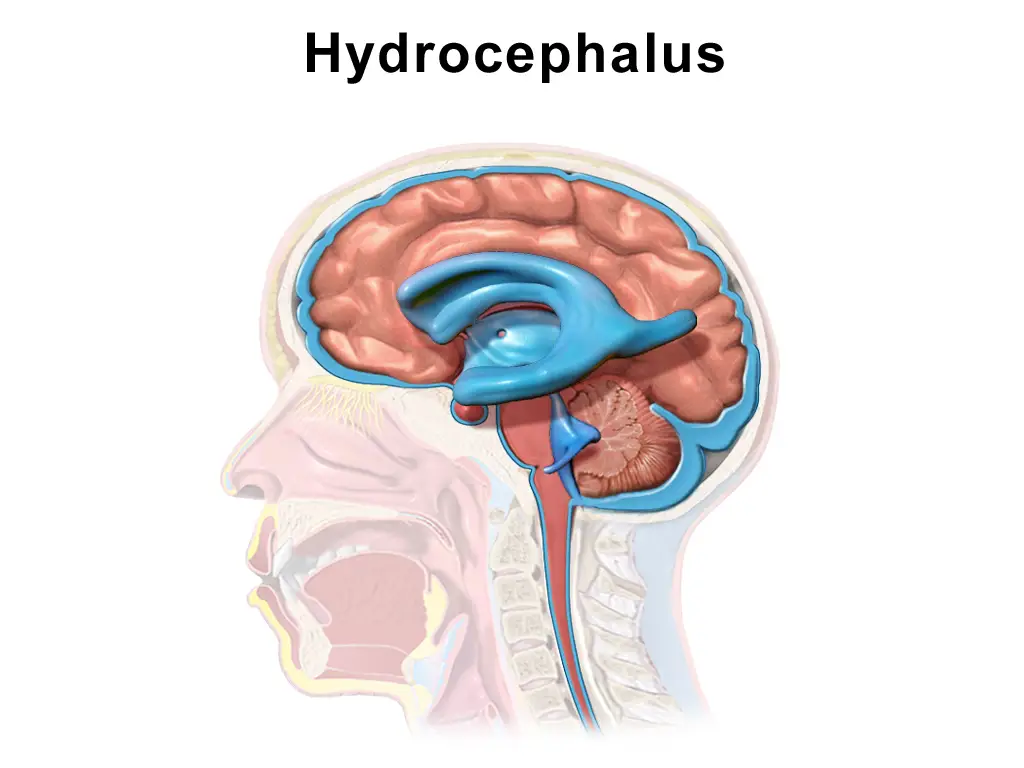 hydrocephalus